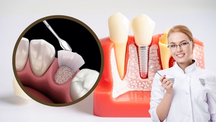 Bone Grafting in Dental Implants Why Its Necessary